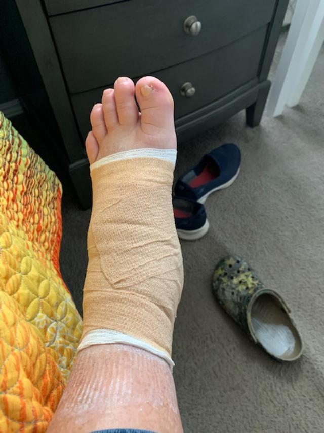 There's a cast on my foot! The white stuff on my leg is from the cast as it dried.