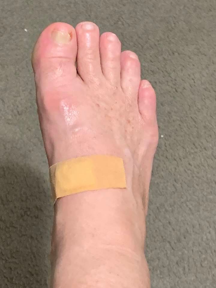 My foot after having the ingrown part of the toenail taken out and the joint injection for arthritis where the bandaid is. This has been very painful for three months.
