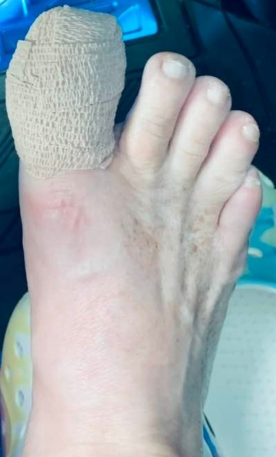 My toe procedure is finished and I am all set to go home.