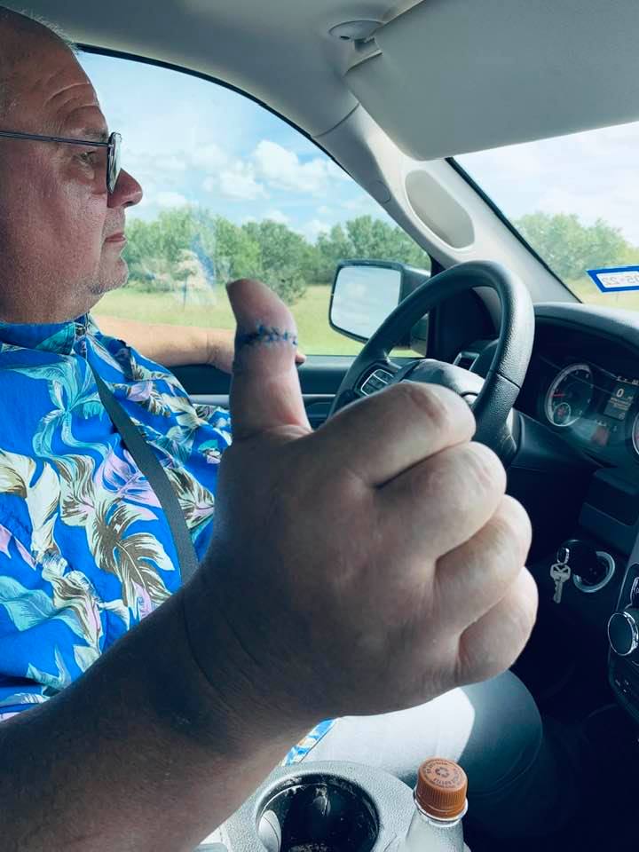 Here is David's thumb with stitches as we drive to the hospital in Jourdanton to have them removed.